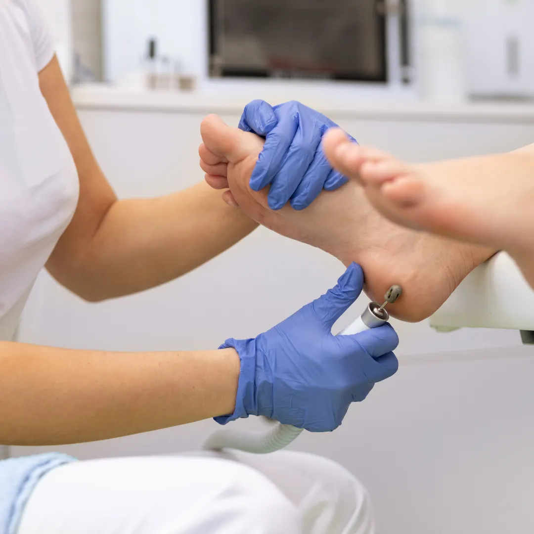 Diabetic Foot Care in Coimbatore