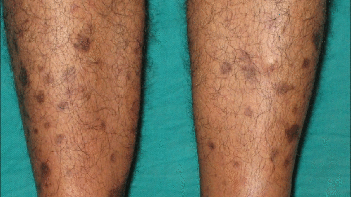 Diabetic Dermatopathy (1)